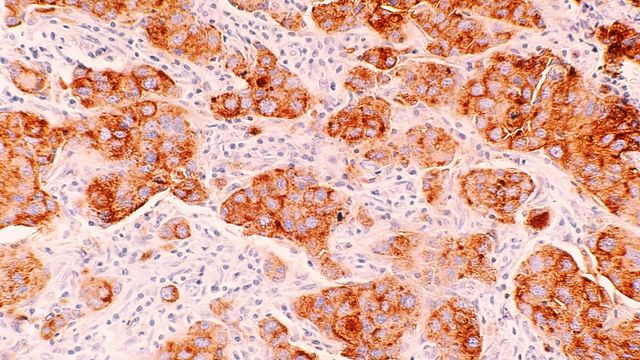 Breast cancer cells, colorized in dark orange and light pink. 