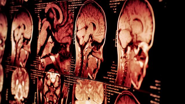 Multiple MRI brain scans showing detailed side and front views for neurological imaging analysis.