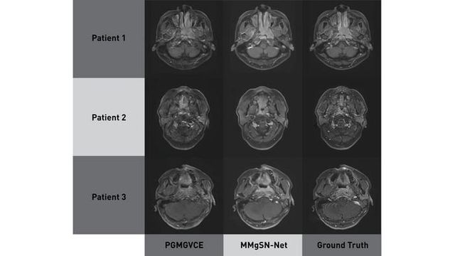 Comparison of brain MRI scans from PGMGVCE, MMgSN-Net, and ground truth showing smoother texture in MMgSN-Net images.